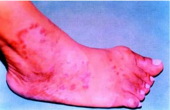 Figure 1B. Aspect of skin lesion in the right foot, after treatment.