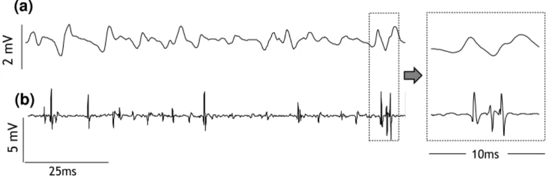 Figure  3-3 -  Example  of  EMG  signals  recorded  with  surface  (a)  and  intramuscular  (b)  electrodes  in  a  single  differential configuration