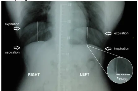 Figure  1  -  Measurement  of  the  mobility  of  the  right  and  left  hemidiaphragms