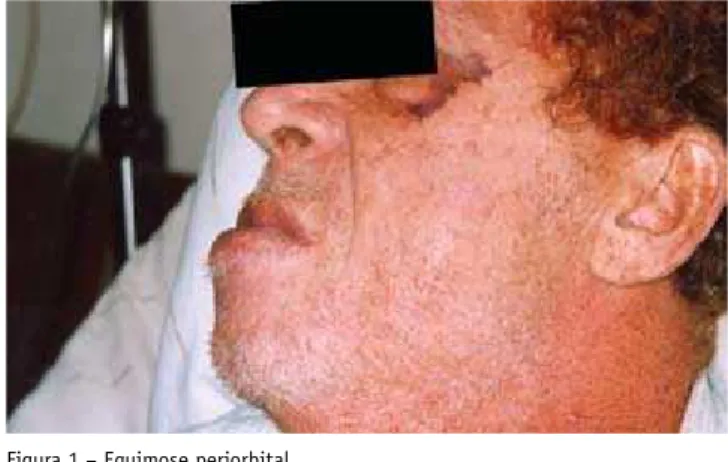 Figura 2 – Macroglossia.