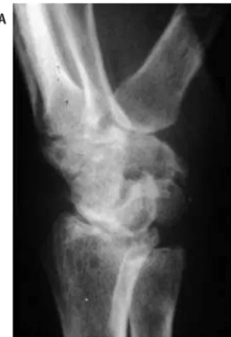 Figura 4 – DISI em paciente com artrite reumatóide. Radiografia em perfil (a), demonstrando aumento do ângulo escafosemilunar