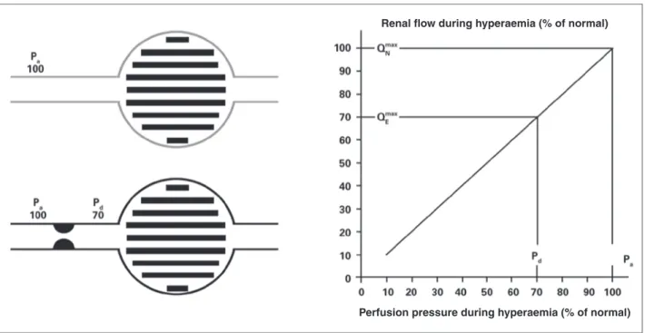 Figure 1 – Deinition of renal fractional low reserve. If there is no stenosis (gray lines), the perfusion pressure determines the maximum normal low  rate (100%) of the renal parenchyma (P a  = P d )