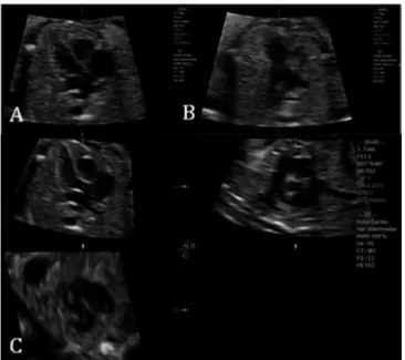 Fig. 2 - Images for evaluating the fetal cardiac screening by four- four-dimensional ultrasonography with spatiotemporal image correlation  (STIC) by multiplanar mode