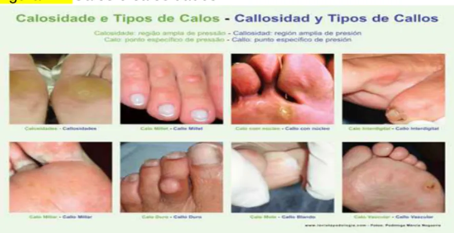 Figura 2 – Calos e calosidades 