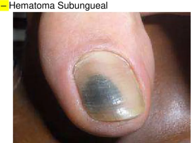 Figura 6 – Hematoma Subungueal 