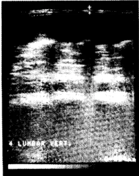 Fig.  1.  Lumbar  fat thickness  assessed  by ultrasonic  machine. 