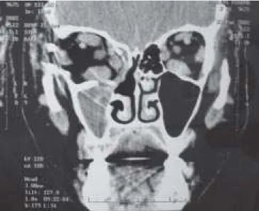 Foto 2.  Velamento do seio frontal direito