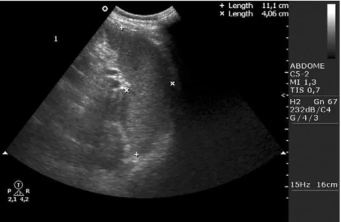 Fig.  3:  transversal  cut  at  the  splenic  hilum  to  measure  the  transver- transver-sal and anteroposterior diameters of the spleen and to allow, together  with the measurement of the longitudinal diameter, the calculation of  the splenic index.