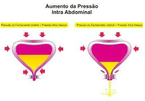 Figura 5: Representação da perda urinária aos esforços.  
