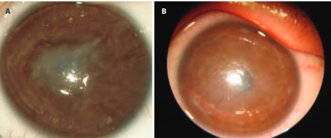 Figure 2.  A) Left eye: Corneal leucoma, epithelial erosion, superficial and deep neovascularisation; B) Left eye: