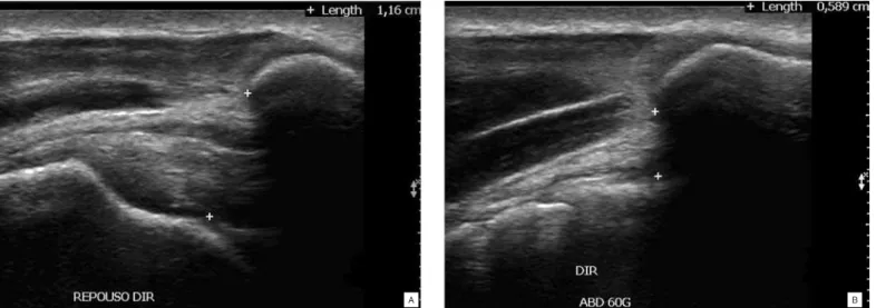 figura 3 – Exame de ultrassonografia para medida da distância acrômio-humeral. Note que quando o ombro está em repouso  (A) existe um bom espaço, porém quando realizamos a abdução a 60 graus (B) este espaço diminui muito em tenistas com  dis-cinesia escapu