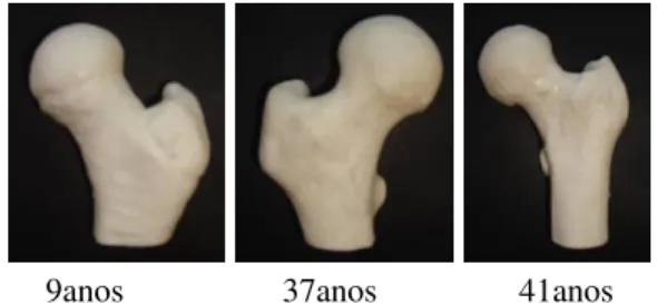 Fig. 1 Imagens tridimensionais de cada fémur. 