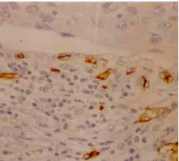 Figura 1 - Fotomicrografia de fragmento cervical com carcinoma invasivo, mostrando imunoexpressão do CD34 (400X).