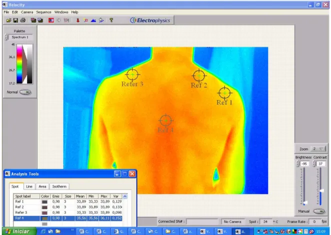 Figura 6 - Termografia da região dorsal em sujeito controle (sem queixa de dor sugestiva de Síndrome  Miofascial de músculo trapézio, termalizado por apenas quinze minutos em ambiente entre 23º C e 24  ºC)