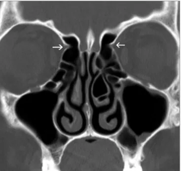 Figure 2. Anterior ethmoidal sulcus - bony  sulcus (tip of arrows) on  the lateral walls of the olfactory fossae, corresponding to the anterior  ethmoidal sulci.