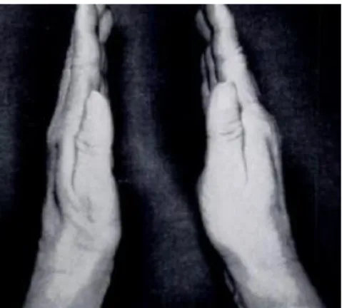 Figura 3 - Vista da mão em perfil ev idenciando a hipotrofia da eminência tênar na mão esquerda