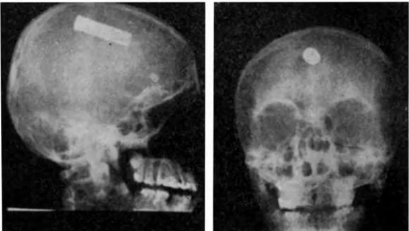 Fig. 2 — Caso L. S. Cartucho retirado  pelo ato cirúrgico. 