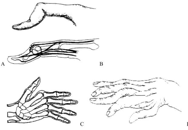 Figura 2 - Deformidades da mão reumatóide: pescoço de cisne (A), botoeira (B), desvio ulnar (C), mão  mutilante (D) (Fonte: DAVID &amp; LLOYD, 2001) 