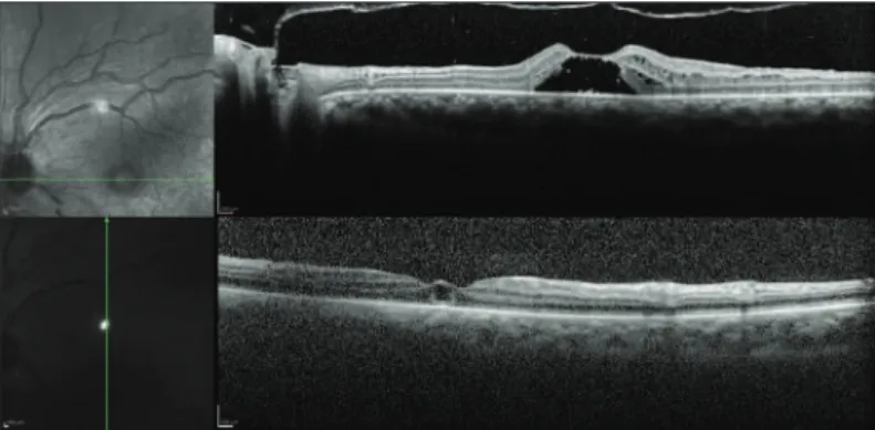 Figure 2. Optical coherence tomography showing intraretinal macular  cysts in the left eye.