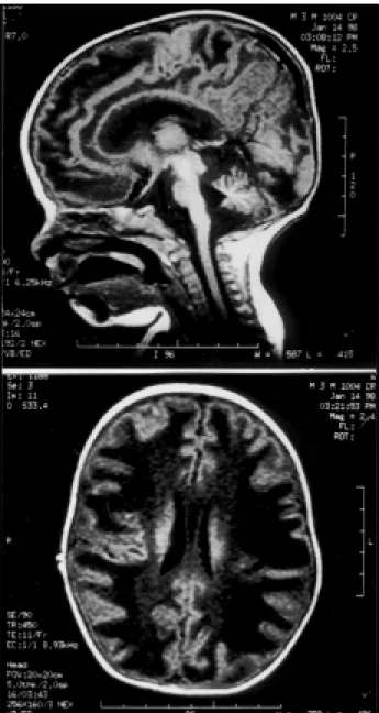 Fig 2 . Brain magnetic resonance at four months showed intense bilateral damaging of white matter and tortuosity of medium brain arteries.