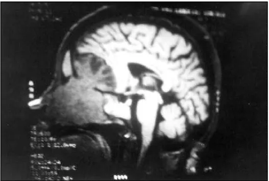 Fig 1. Preoperative sagittal MRI of the tumor, involving the ethmoid sinus, sphenoid sinus, nasal cavity and frontal lobe.