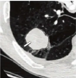 Figura 2.10: Linha ortogonal traçada sobre a borda do nódulo pulmonar. Fonte: Imagem ex- ex-traída de (XU et al., 2012).
