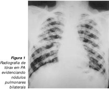 Figura 3  –  A)  M aterial obtido de tecido pulmonar evidenciando Coccidioides immitis sob a forma de esférula com ruptura em sua parede (microscopia óptica, PAS, 40x)