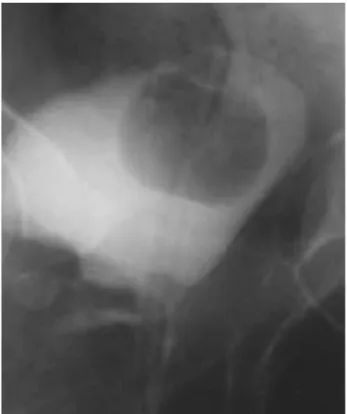 Figure 4 - Cystographic control showing minimum extravasa- extravasa-tion of contrast medium and descending of bladder to its  ana-tomical position.