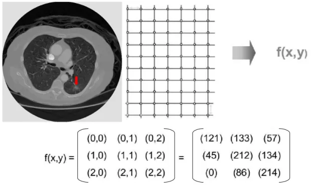 Figura 2: Representação da função de uma imagem digital de Tomografia Computadorizada de pulmão que apresenta um nódulo (apontado pela seta vermelha).