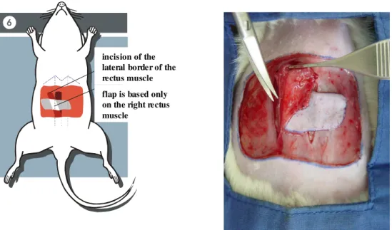 FIGURE 6  - Drawing and photography that shows the incision of the lateral border of the  right rectus abdominis muscle, for elevation of the flap