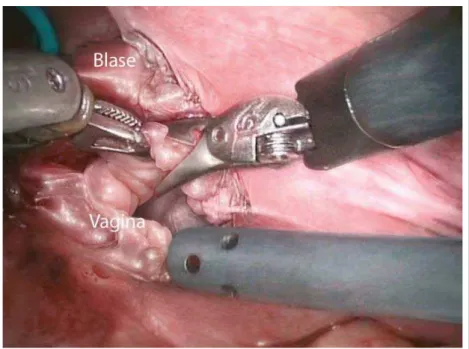 Abbildung 5: Exzision des Fistelkanals. Die perioperative Fistelschienung ist zur Fistelerkennung im Spatium vesiko- vesiko-vaginale hilfreich (laparoskopisch-roboterassistierte Technik).