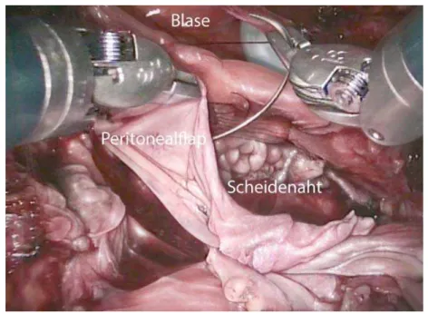 Abbildung 6: Nach dem Scheidenverschluss wird die vaginale Nahtreihe mit einem Peritoneallappen gedeckt.