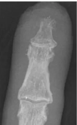 Figura  2. Primeira  consulta:  radiografia  do  terceiro  dedo  da  mão esquerda – acro-osteólise no tofo da falange distal.