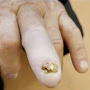 Figura 6. Consulta  de  reavaliação:  terceiro  dedo  da  mão  esquerda após novo ciclo de antibioterapia com flucloxacilina.