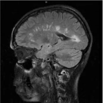 Figura 3. Ressonância magnética crânio-encefálica e da coluna cervi- cervi-cal (corte sagital).