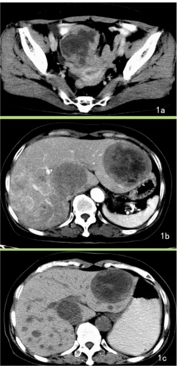 Fig 1. Jejunum GISTs with liver metastasis. A 64-year-old female with jejunum GISTs with liver metastasis presented with clinical abdominal pain for 6 months, and ultrasound examination detected liver masses for 1 week