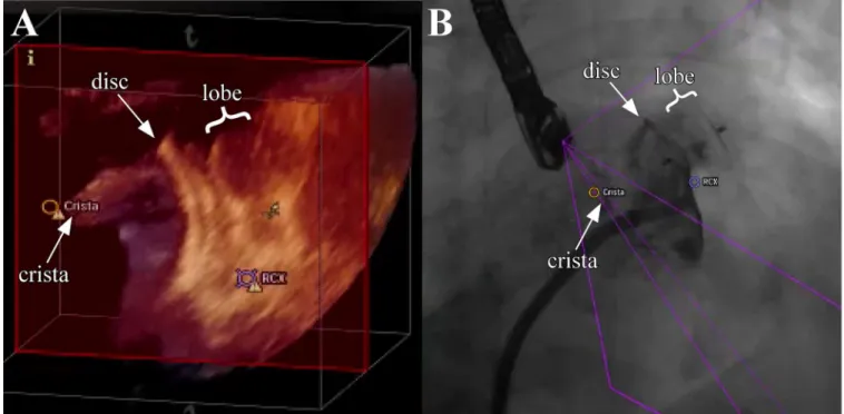 Fig 4. Evaluation of adequate device position and stability by using 3D-TEE and fluoroscopy