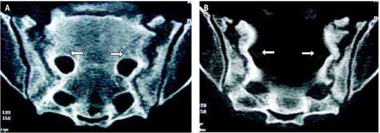 Figura 4 – Mulher, 76 anos, história de d or sem trauma definido. A e B) TC coronal e axial m ostrando fratura exten sa bilateral.