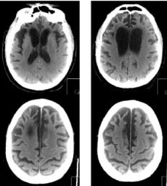 Figura 3. Cortes axiais de TC cerebral do doente (julho de 2010).