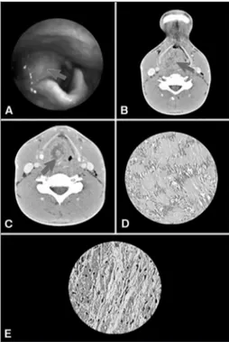 Figure 1. A: Tumor in the right aryepiglottic fold obliterating the  ipsilateral piriformis sinus (arrow); B: Heterogeneous image  obli-terating the pharyngeal lumen (CT scan of the supraglottis - axial  view - arrow); C: Tumor obstructing the glottis and 