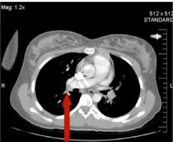 Figura 2. Imagem de TC contrastada do tromboembolismo pulmo- pulmo-nar (mais evidente à direita – seta) em 26/08/2006.
