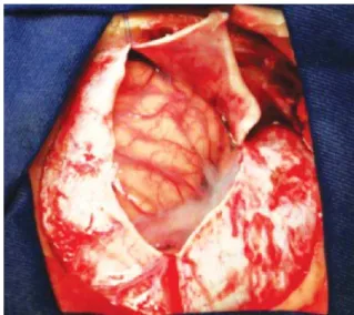 Figure 4. The dura is opened through the sylvian fissure  toward the superior orbital fissure
