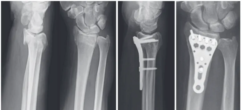 Fig 2. Example of AO 23 C2 fracture lateral and ap (anterior-posterior) view preoperative and 15 weeks postoperative x-rays stabilized with Königsee locking plate.