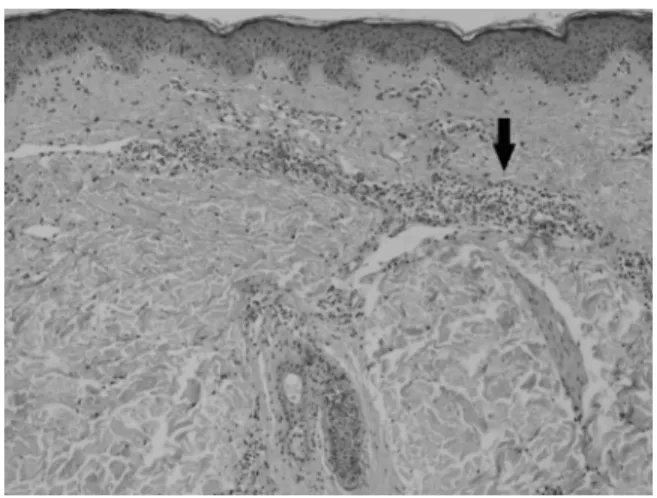 Figure 1 – Flagellate dermatitis in upper back, with hyperchromia and a “whip-like” pattern.
