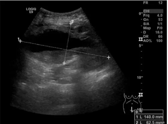 Figura 1: Ecografia abdominal - Hematoma do recto abdominal de 140 x 62,5 mm de maiores diâmetros longitudinal e transversal  respectivamente.