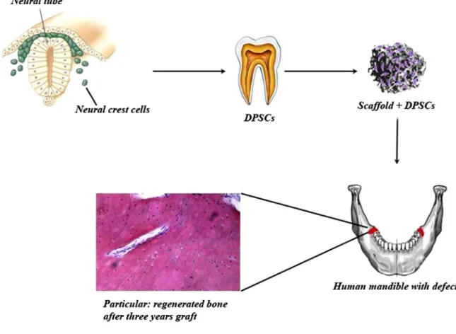 Fig. 1. Representation of human mandible defect repair using DPSCs seeded on a scaffold.