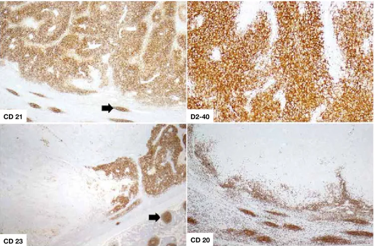 Figura 5:  Coloração imunohistoquímica. Detalhe da imunomarcação das células neoplásicas com positividade forte e difusa para  CD21 e podoplanina (D2-40) e focal para CD23 (observe-se a marcação das células foliculares dendríticas não-neoplásicas no  centr
