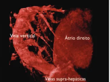 Figura 5 - Coarctação de aorta.