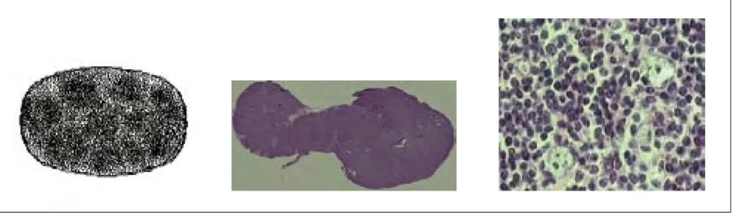 Fig. 1 – LH Nodular de Predomínio de Linfócitos. Da esquerda para a direita, esquema, fragmento ganglionar macroscópico e imagem  de microscopia óptica