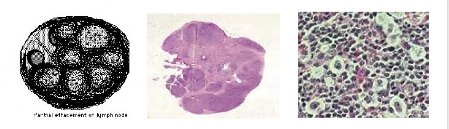 Fig. 3 – LH tipo Celularidade Mista. Da esquerda para a direita, esquema do gânglio e  imagem de microscopia óptica